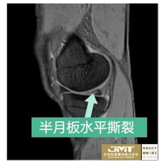 JMT日本干细胞-半月板损伤断裂的干细胞治疗