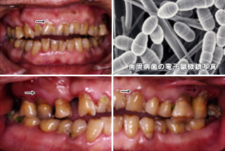 JMT日本干细胞治疗牙周病-牙周病是什么？
