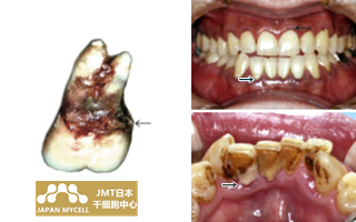 JMT日本干细胞治疗牙周病-牙周病形成的原因及症状