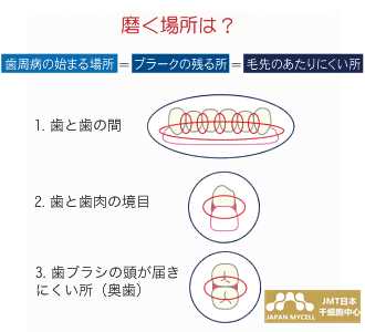 JMT日本干细胞治疗牙周病-牙周病的常见治疗方法