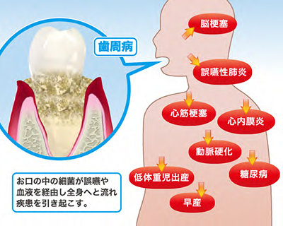 JMT日本干细胞治疗牙周病-牙周病菌对全身的影响