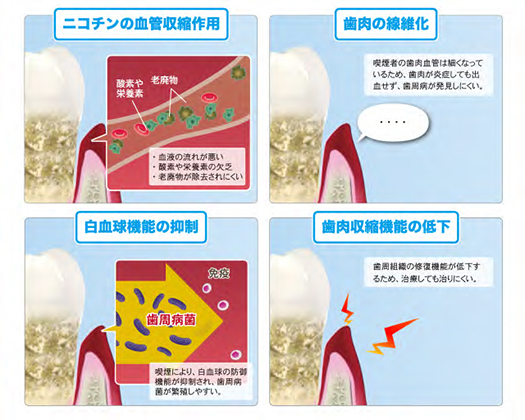 JMT日本干细胞治疗牙周病-吸烟对牙周病的影响