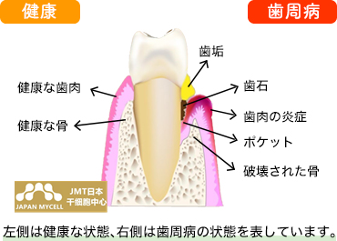 JMT日本干细胞治疗牙周病-吸烟对牙周病的影响