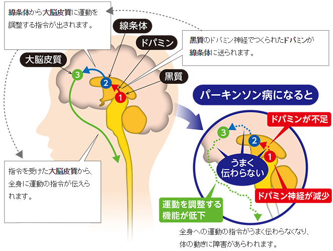 JMT日本干细胞治疗帕金森-帕金斯病的症状、诊断和治疗