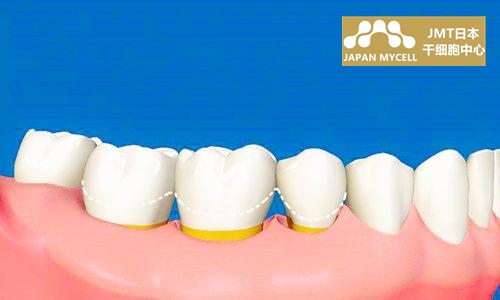 JMT日本干细胞中心干细胞治疗牙周病-关于牙周病的疑问解答④