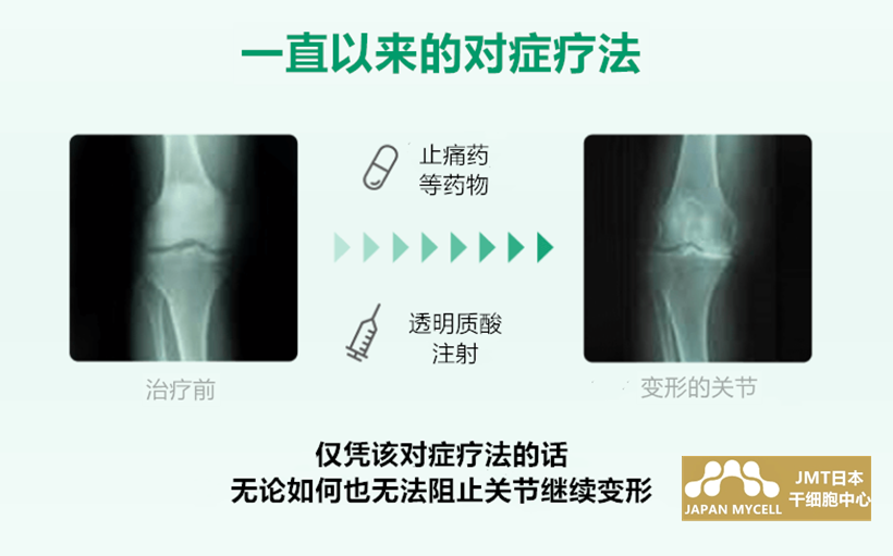 JMT日本干细胞中心-干细胞治疗膝盖疼痛、变形性膝关节病的介绍