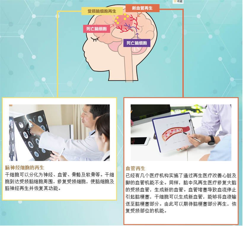 JMT日本干细胞中心-心源性脑梗塞脑中风的治疗方法