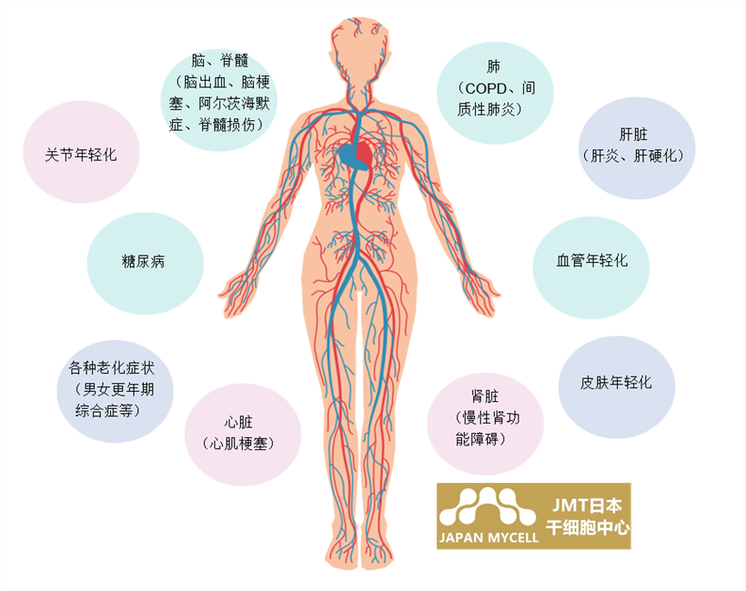 JMT日本干细胞中心-干细胞如何治疗脑中风及脑中风的类型