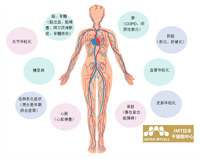 JMT日本干细胞中心-心梗的常见治疗方式及干细胞治疗