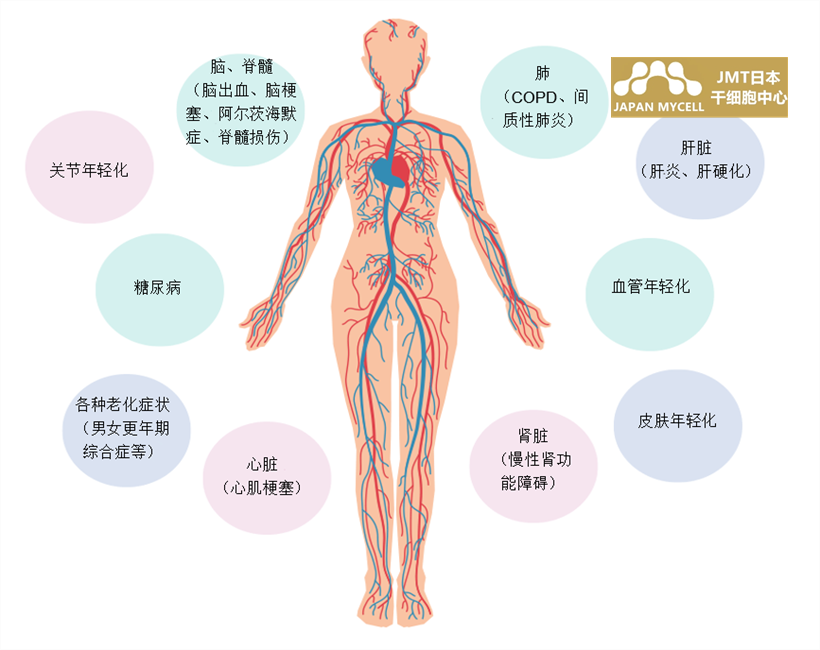JMT日本干细胞中心-心肌梗塞的干细胞治疗