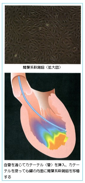 JMT日本干细胞中心-心脑血管心脏病的干细胞治疗说明