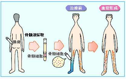 JMT日本干细胞中心-心脑血管干细胞治疗的现状