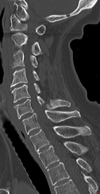 JMT日本干细胞中心-脊髓损伤脊椎损伤的干细胞治疗
