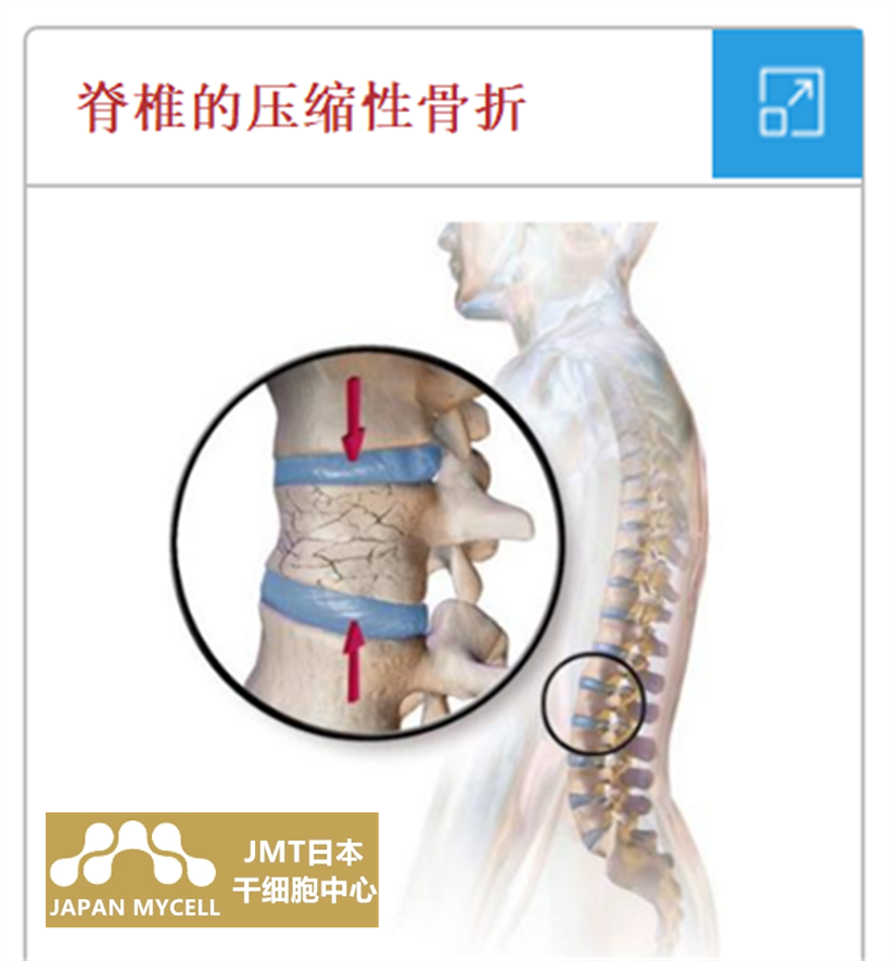 JMT日本干细胞中心-脊髓脊椎损伤瘫痪脊椎骨折及干细胞治疗