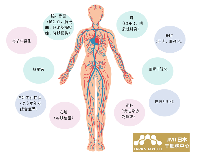 JMT日本干细胞中心-脑中风脑出血脑梗的康复及干细胞的治疗