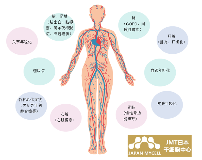 JMT日本干细胞中心-脑中风脑梗脑出血原因症状及干细胞治疗