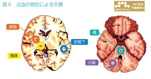 JMT日本干细胞中心-脑中风脑梗脑出血最大的原因及干细胞治疗