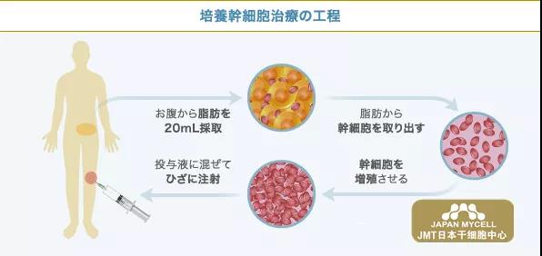 JMT日本干细胞中心-日本人如何治疗变形性膝关节症