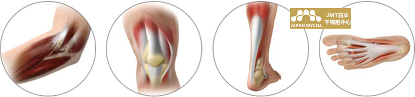 JMT日本干细胞中心-膝盖手肘肩腰关节的干细胞治疗