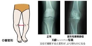 JMT日本干细胞中心-针对变形性膝关节症的再生医疗（自体脂肪由来间叶系干细胞治疗）（上）