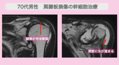 JMT日本干细胞案例-70多岁日本男性左肩袖完全撕裂胳膊抬不起来的干细胞治疗
