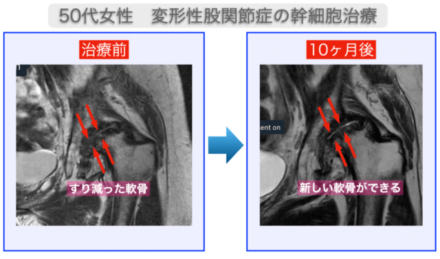 JMT日本干细胞案例-50多岁女性，治疗10个月后股关节软骨实现再生