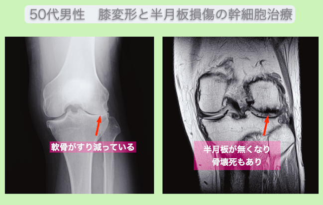 JMT日本干细胞案例-50多岁日本男性常年练习空手道，对膝部变形和肩腱板损伤进行干细胞治疗