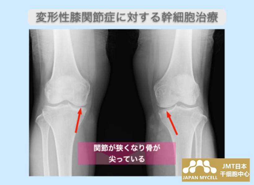 JMT日本干细胞案例-70多岁日本女性中期变形性膝关节症的干细胞治疗