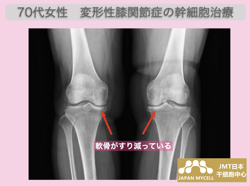 JMT日本干细胞案例-70多岁日本女性变形性膝关节症的干细胞治疗