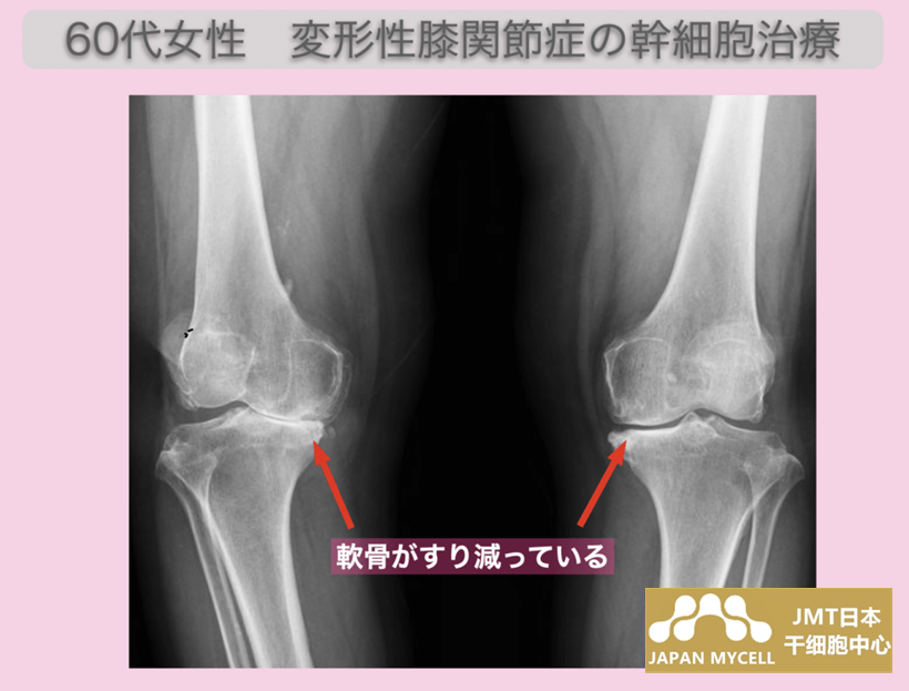 JMT日本干细胞案例-60多岁日本女性变形性膝关节症末期变形严重走路困难的干细胞治疗