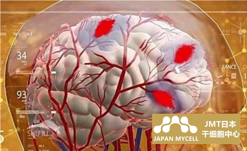 JMT日本干细胞中心-脑出血、脑梗塞后遗症的相关用语说明