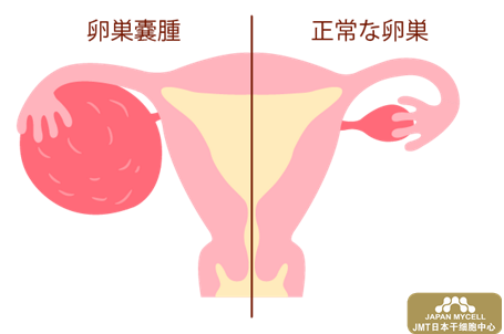 干细胞治疗卵巢——卵巢囊肿卵巢癌类型及症状