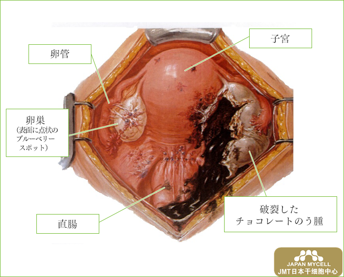 干细胞治疗卵巢-子宫内膜异位症及其症状（二）