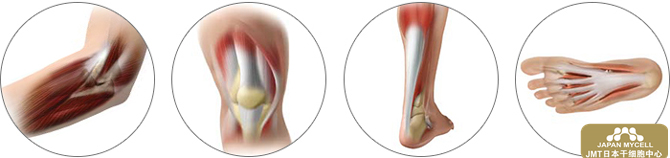 日本干细胞-膝盖、手肘、肩、腰、关节的干细胞治疗
