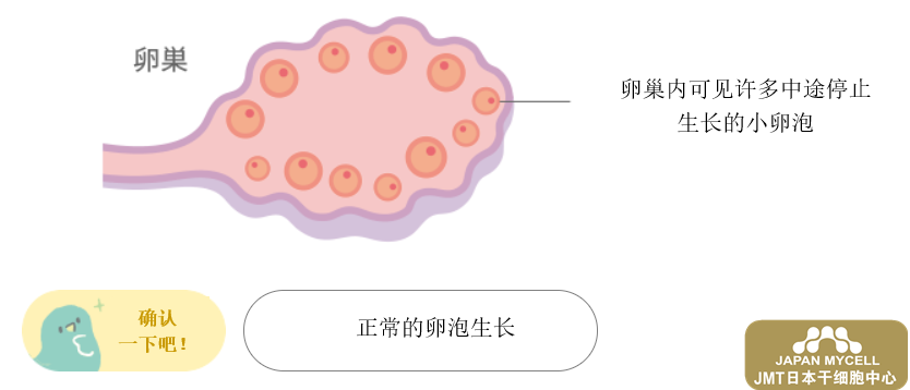 干细胞治疗卵巢——多囊卵巢综合征的解释及治疗
