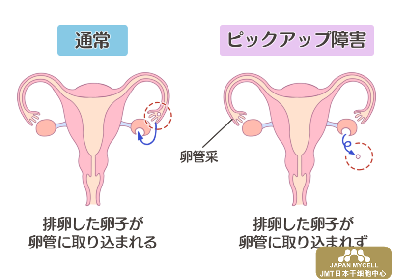 男性不孕症的原因和检查-日本干细胞治疗