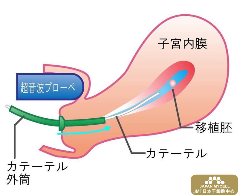 日本干细胞-卵子冷冻·卵巢组织冷冻的方法及日本干细胞恢复卵巢功能