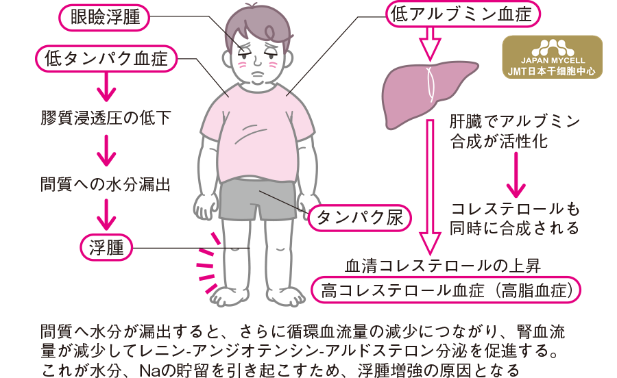 肝肾功能障碍之肾病综合症（NS）检查方方法及预后-日本干细胞如何治疗