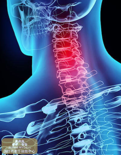 JMT日本干细胞中心-脊椎脊髓损伤后会出现哪些症状？