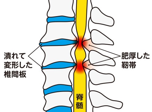 JMT日本干细胞中心-脊髓损伤・难治性脊髓病的治疗（上）