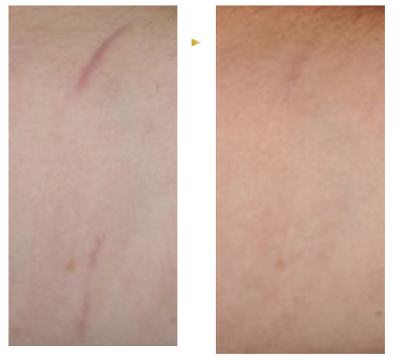 JMT日本干细胞修复疤痕--“无需动刀”的新型割腕伤痕祛除、修正术