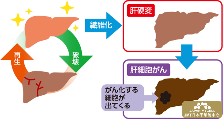 JMT日本干细胞中心-肝硬化患病原因分析及日本干细胞治疗评估