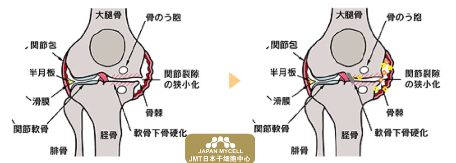 JMT日本干细胞-关于使用自体脂肪间充质干细胞治疗膝骨关节炎②