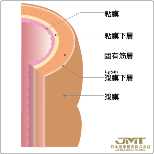 JMT日本干细胞——大肠癌（结肠癌·直肠癌）的疾病分期与治疗选择