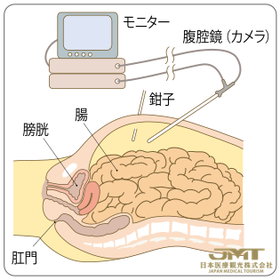 JMT日本干细胞——大肠癌（结肠癌·直肠癌）的手术外科治疗②