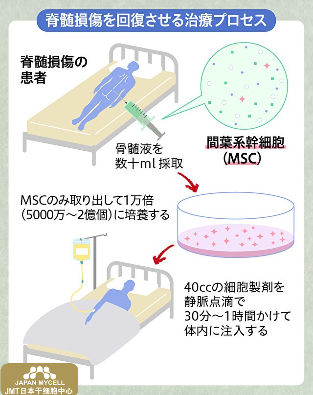 JMT日本干细胞中心-为治疗脊髓损伤带来光明，用自己的细胞进行神经再生，札幌医大的干细胞治疗②