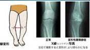 骨关节炎的再生医学（自体脂肪衍生间质干细胞治疗膝盖）