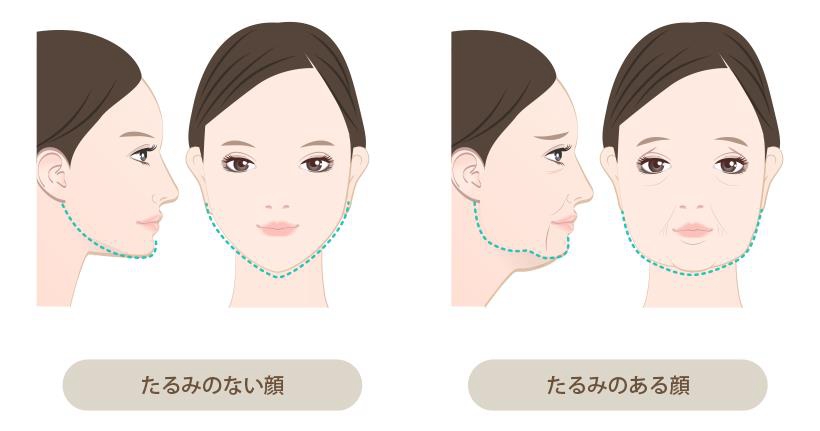 日本干细胞-不知不觉中衰老，其原因可能在于“面部松弛”