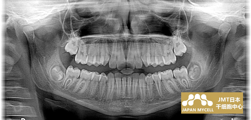 JMT日本牙髓干细胞-深入解释说明牙齿中存在的间充质干细胞“牙髓干细胞”！