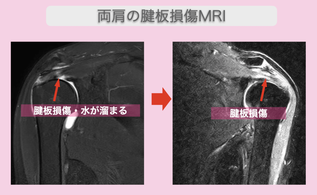 JMT日本干细胞案例-50多岁日本女性两肩肩袖损伤的干细胞治疗经过